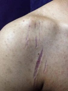 ជំងឺរហែកស្បែក ឬជំងឺរយះស្បែក បណ្តាលមកពីបកជ្រុល ឬឡេកាត់ជ្រុល ធ្វើឲ្យស្បែកស្តើង រយះ ។ ជំងឺនេះជួបច្រើន ពិបាកព្យាបាលខ្លាំងណាស់..