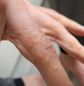 តើអ្នកធ្លាប់មានកន្ទួលរមាស់ អេះស្រួល លើម្រាមដៃឬស្បែកបែបនេះឬអត់?